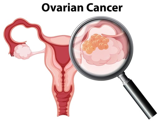 Ovarian Cancer Treatment