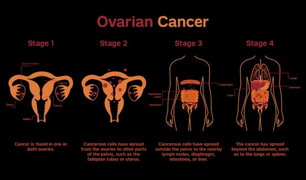 علاج سرطان المبيض - Image 3