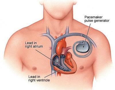 Pacemaker Implantation Surgery