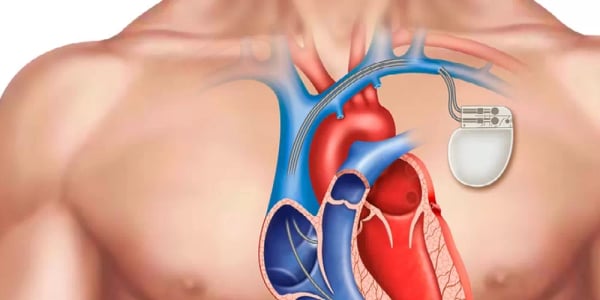 Pacemaker Implantation Surgery - Image 2