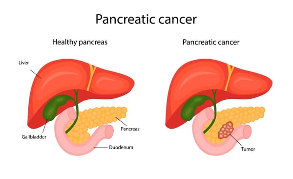 Pancreatic Cancer Treatment - Image 2
