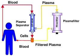 Plasmapheresis - Image 2