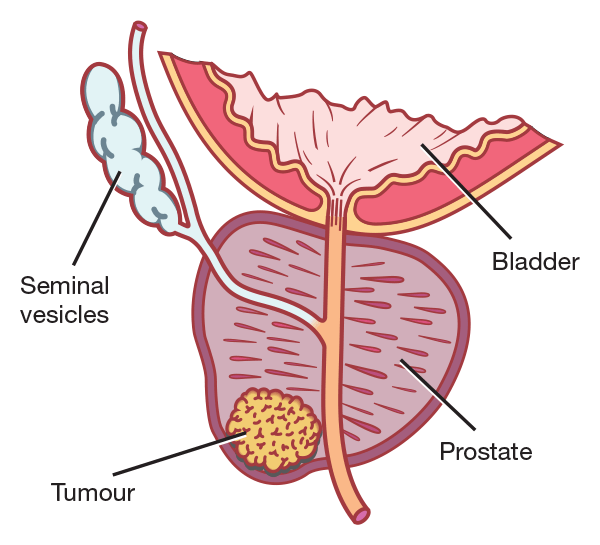 Prostate Cancer Treatment