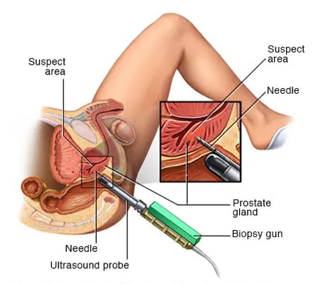 Prostate Cancer Treatment - Image 2