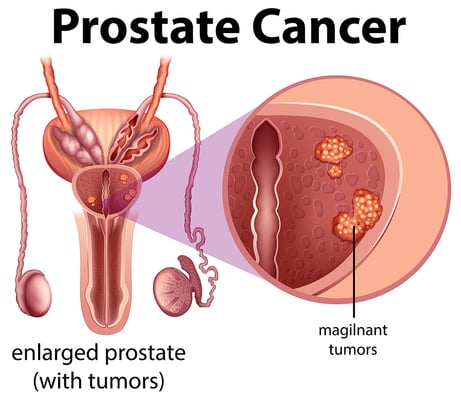 Prostate Cancer Treatment - Image 3
