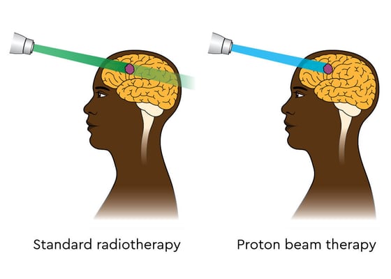 العلاج بالبروتون - Image 2