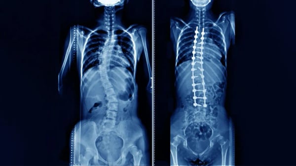Scoliosis Spine Surgery