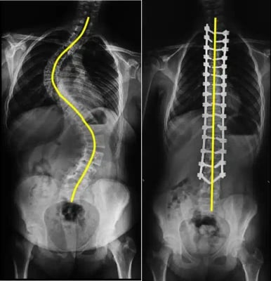 Scoliosis Spine Surgery - Image 2