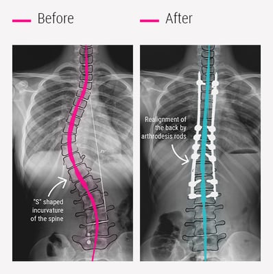 Scoliosis Spine Surgery - Image 3