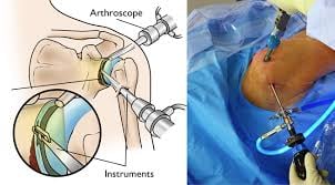 Shoulder Arthroscopy - Image 2