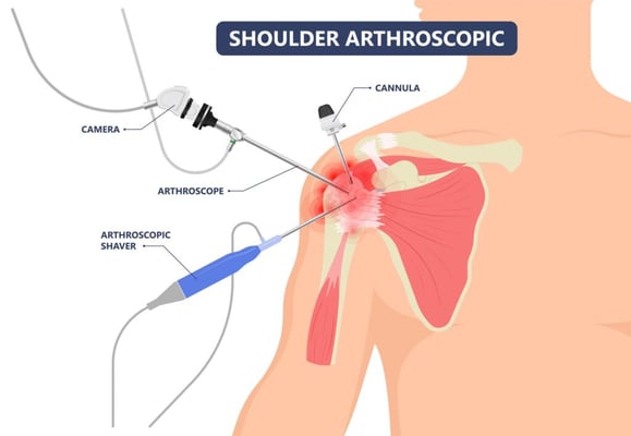 Shoulder Arthroscopy - Image 3