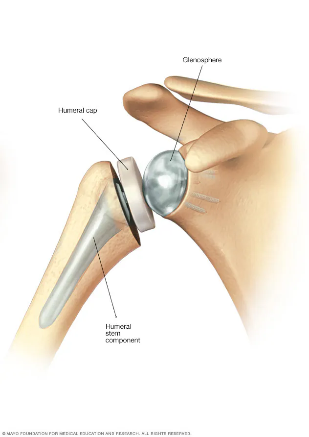 Shoulder Replacement Surgery