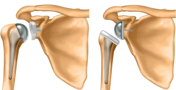 Shoulder Replacement Surgery - Image 2
