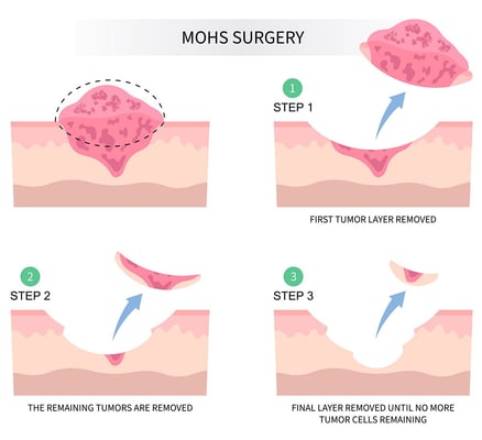 علاج سرطان الجلد - Image 2