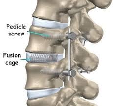 Spinal Fusion Surgery