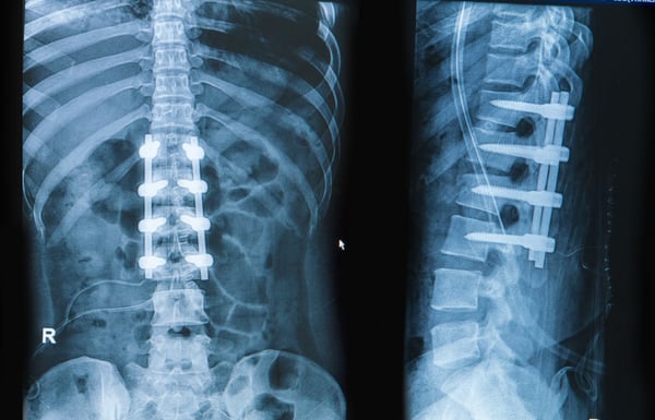 Spinal Fusion Surgery - Image 3