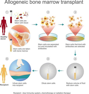 Stem Cell Transplant