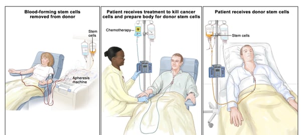 Stem Cell Transplant - Image 2