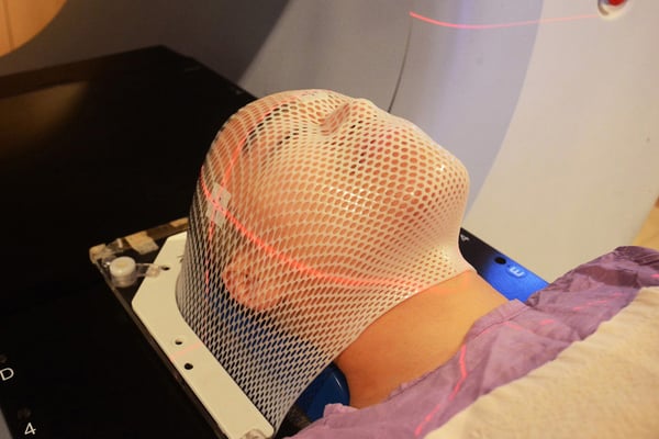 Stereotactic Radiotherapy (SRT)