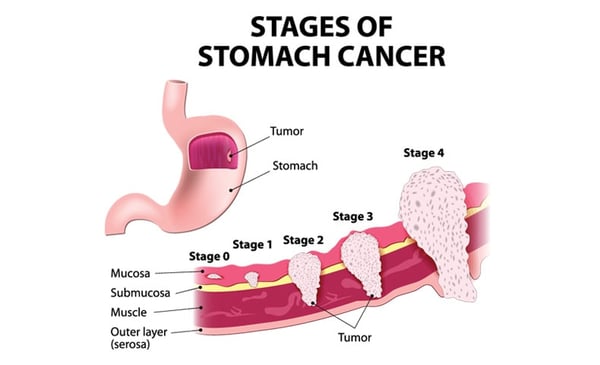 Stomach Cancer Treatment