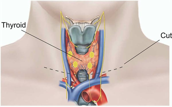 Thyroidectomy - Image 2