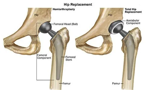 Total Hip Replacement - THR