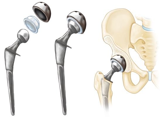 Total Hip Replacement - THR - Image 2