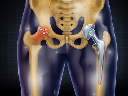 Total Hip Replacement - THR - Image 3