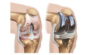 Total Knee Replacement - TKR