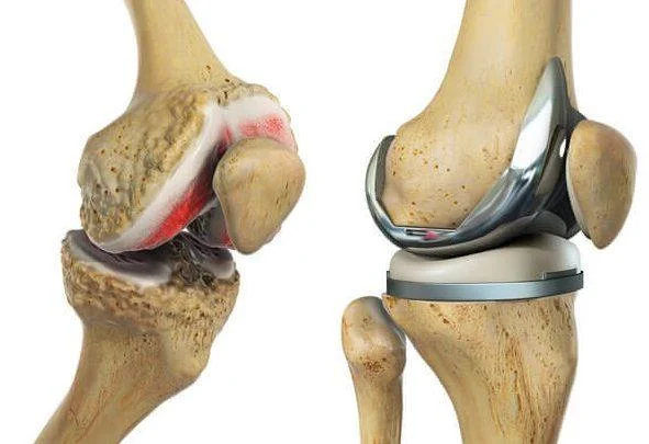 Total Knee Replacement - TKR - Image 2