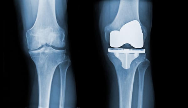 Total Knee Replacement - TKR - Image 3