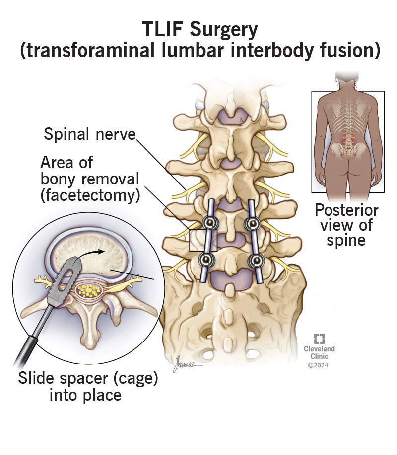 Transforaminal Lumbar Interbody Fusion - TLIF Surgery