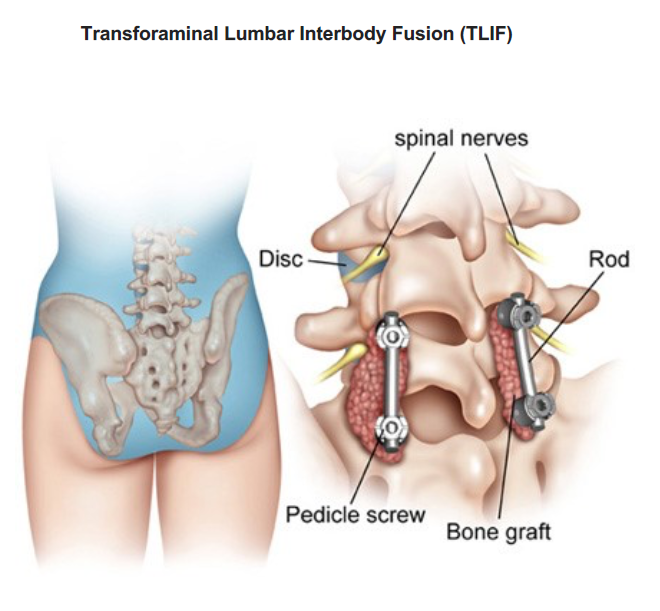 Transforaminal Lumbar Interbody Fusion - TLIF Surgery - Image 2