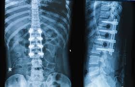 Transforaminal Lumbar Interbody Fusion - TLIF Surgery - Image 3