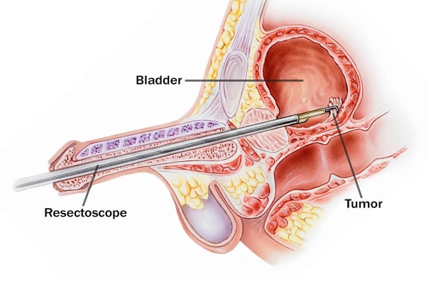 Transurethral Resection of Bladder Tumor (TURBT)