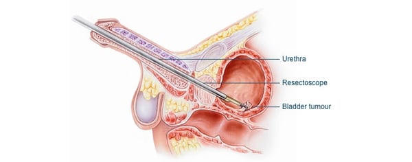 Transurethral Resection of Bladder Tumor (TURBT) - Image 2