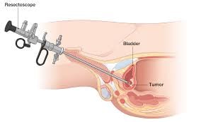 Transurethral Resection of Bladder Tumor (TURBT) - Image 3