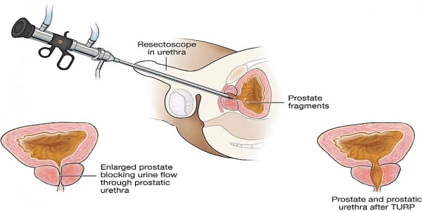 Transurethral Resection of Prostate (TURP)