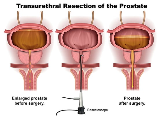Transurethral Resection of Prostate (TURP) - Image 2