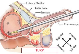Transurethral Resection of Prostate (TURP) - Image 3