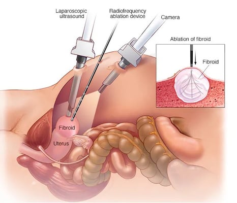 Uterine Fibroid Removal