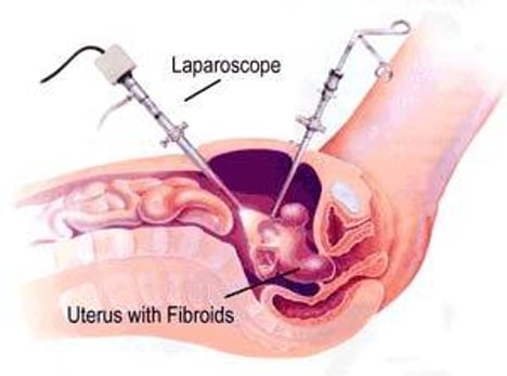 Uterine Fibroid Removal - Image 2