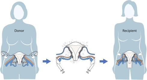 Uterus Transplant - Image 2