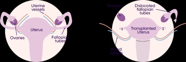 Uterus Transplant - Image 3