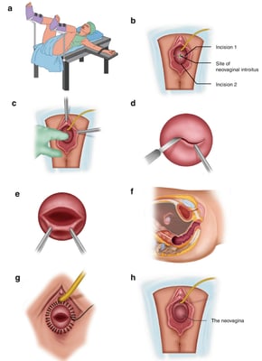 Vaginoplasty - Image 2