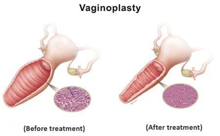 Vaginoplasty - Image 3