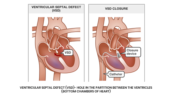 Ventricular Septal Defect - VSD Surgery