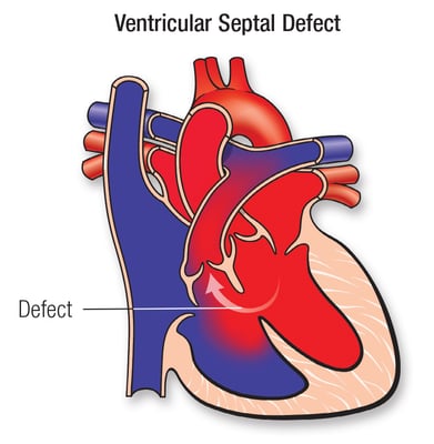 Ventricular Septal Defect - VSD Surgery - Image 2
