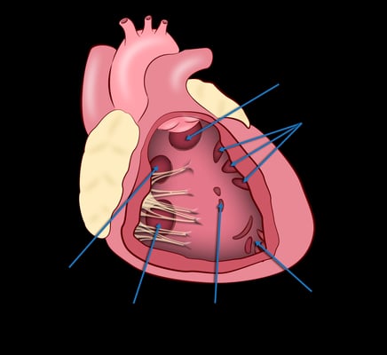 Ventricular Septal Defect - VSD Surgery - Image 3