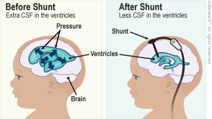 VP Shunt Surgery